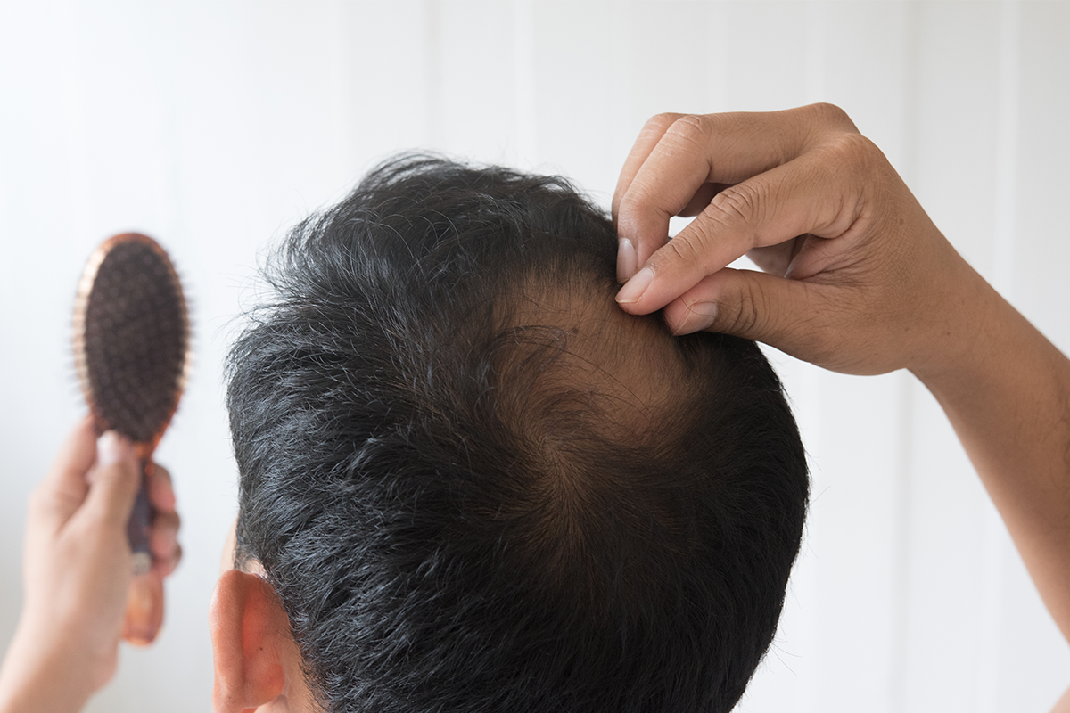 Hair Fall in India: Top Causes & a Science-Backed Routine to Reduce It