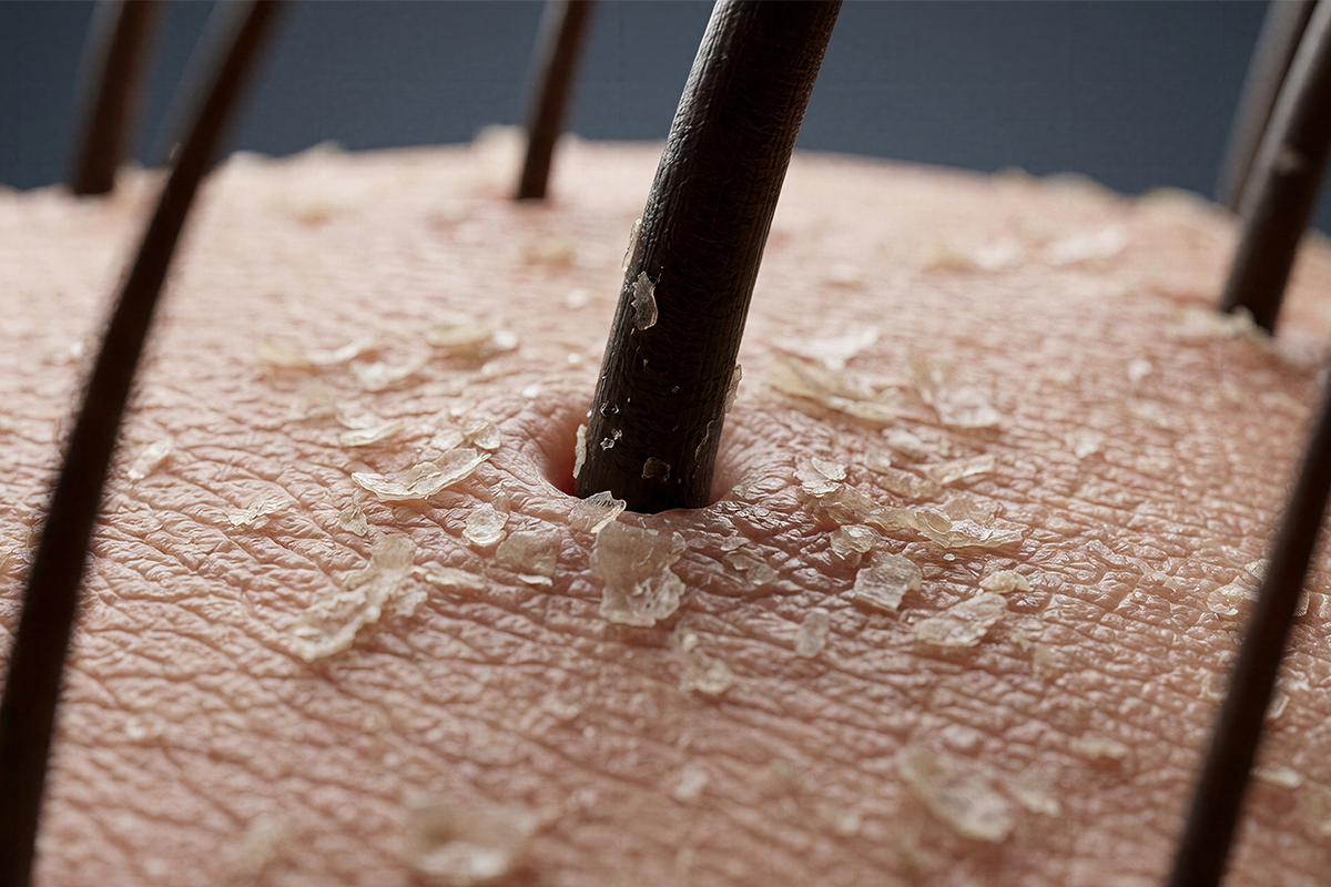 Dandruff vs. Dry Scalp: How to Tell the Difference and Treat Each the Right Way