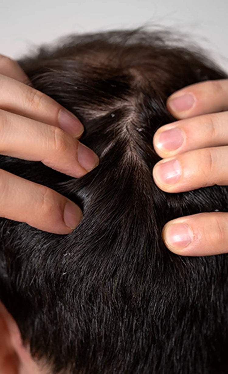 Controlled<br>dandruff
