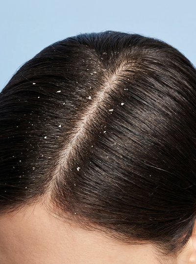 ANTI-DANDRUFF
