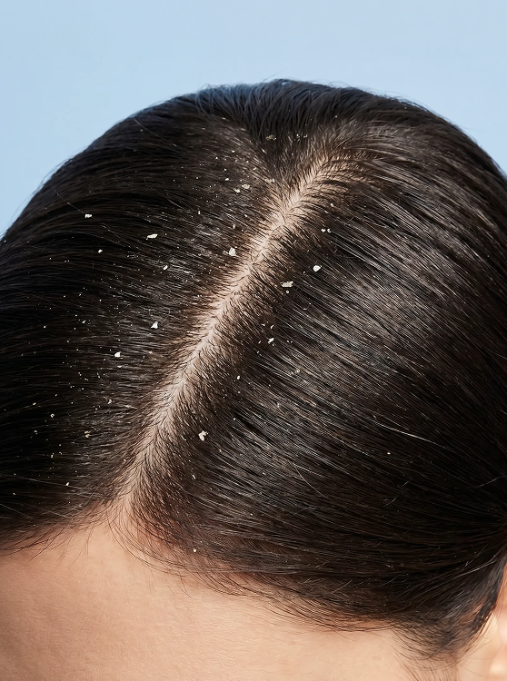 ANTI-DANDRUFF